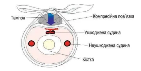 «Схема дії компресійної пов'язки» — поперечний розріз кінцівки з підписами: тампон (синя стрілка тиску згори)…
